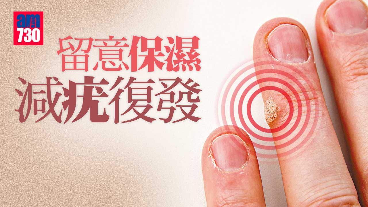 注重保濕 減疣復發