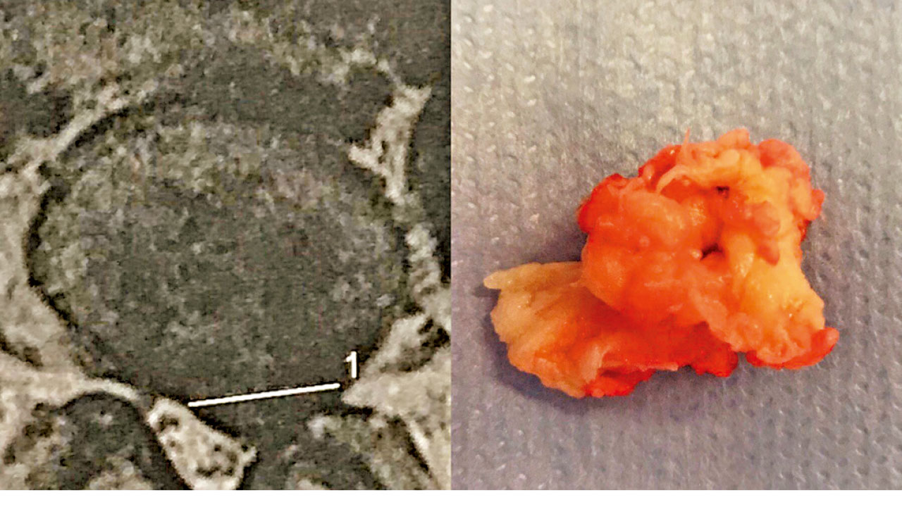 治療坐骨神經痛 應否堅持「動態清零」？