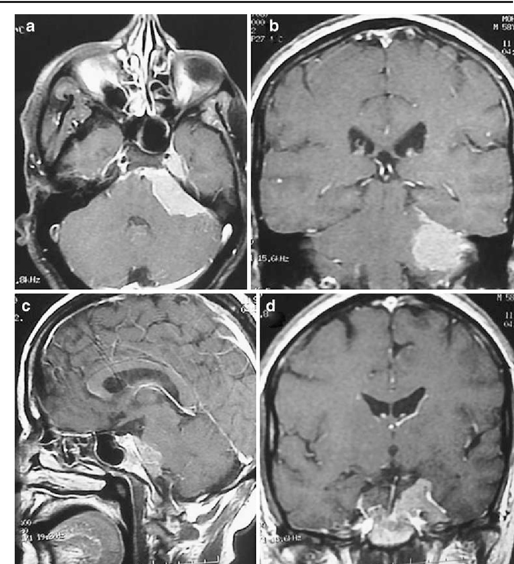天幕裂孔區腦膜瘤
