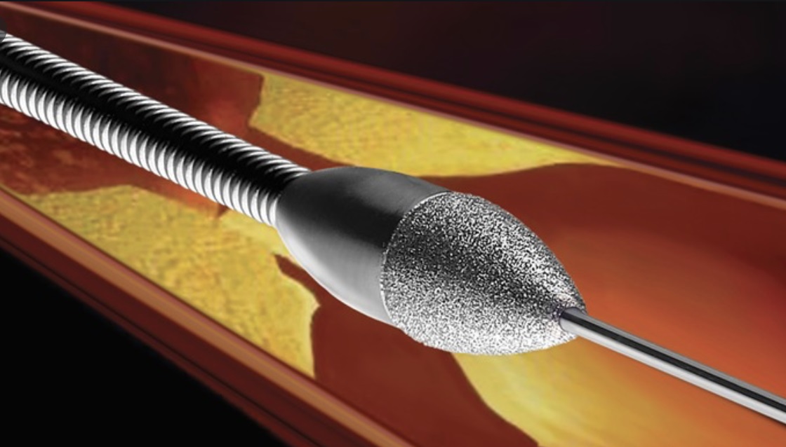 冠狀動脈斑塊旋磨術