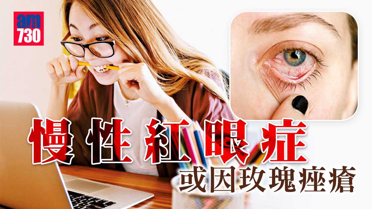 慢性紅眼症 或因玫瑰痤瘡