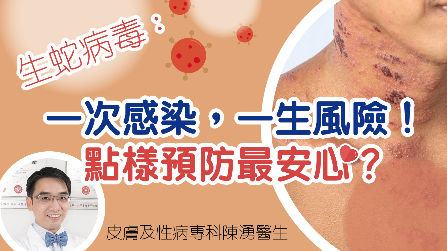 生蛇病毒：一次感染，一生風險！點樣預防最安心？