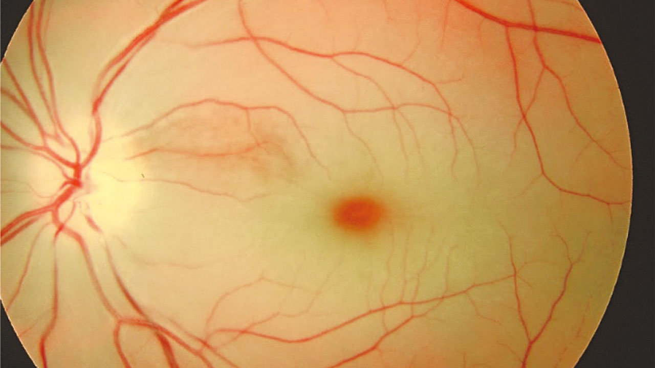 三高與視網膜血管疾病(一)