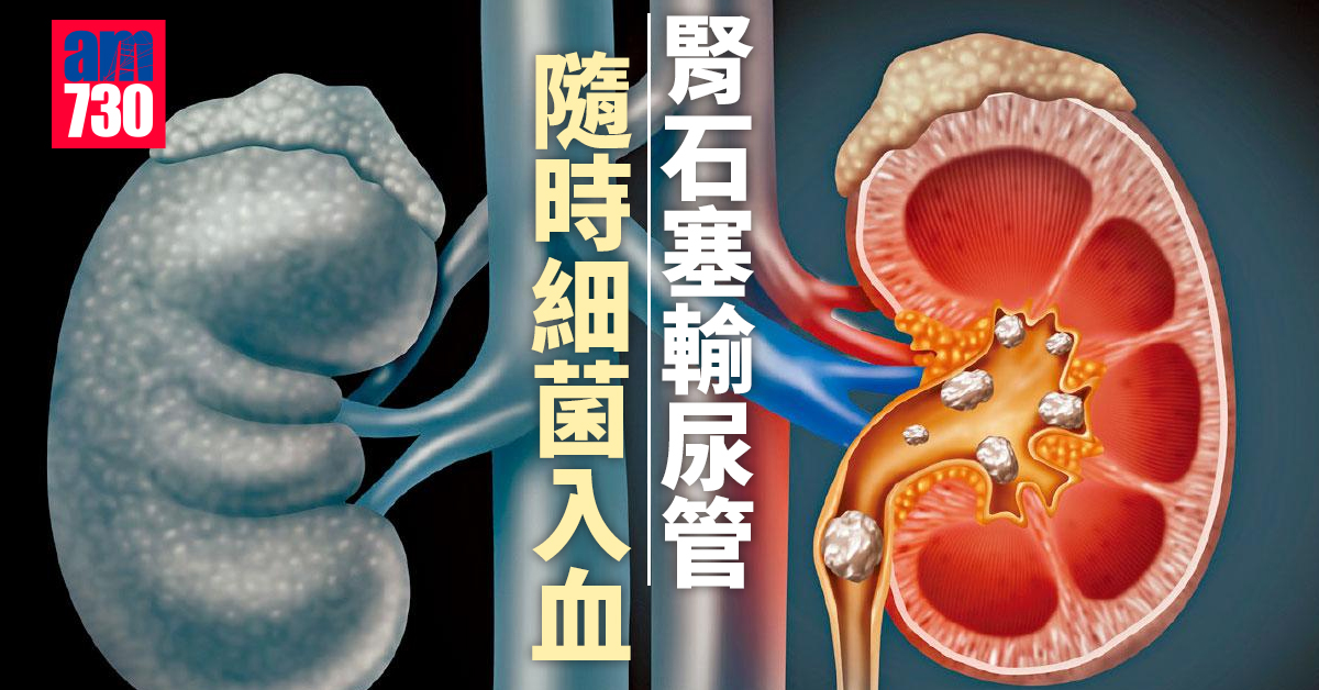 腎石塞輸尿管 隨時細菌入血