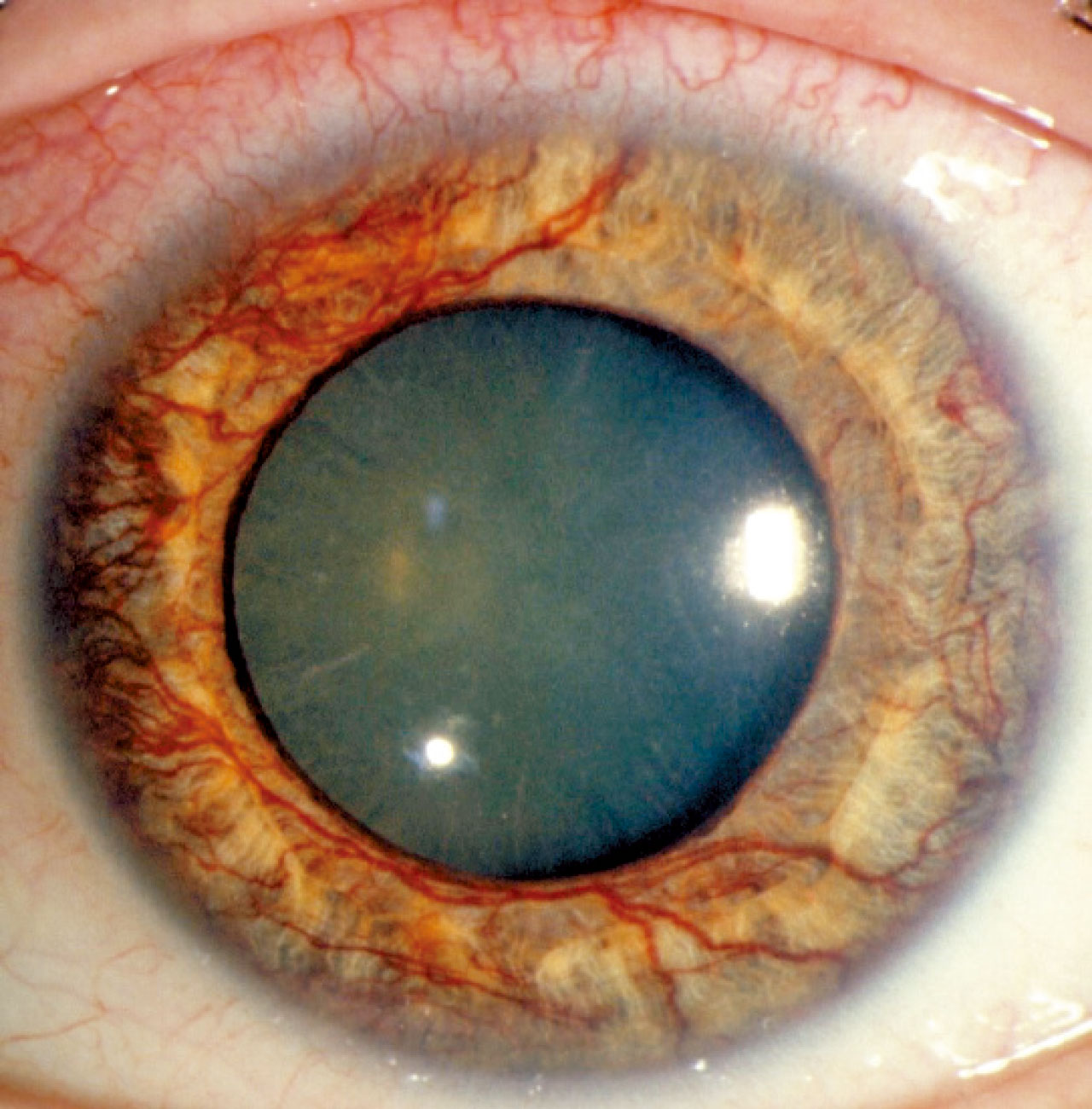 三高與視網膜血管疾病(三)