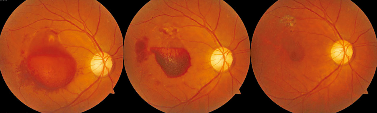 三高與視網膜血管疾病(四)