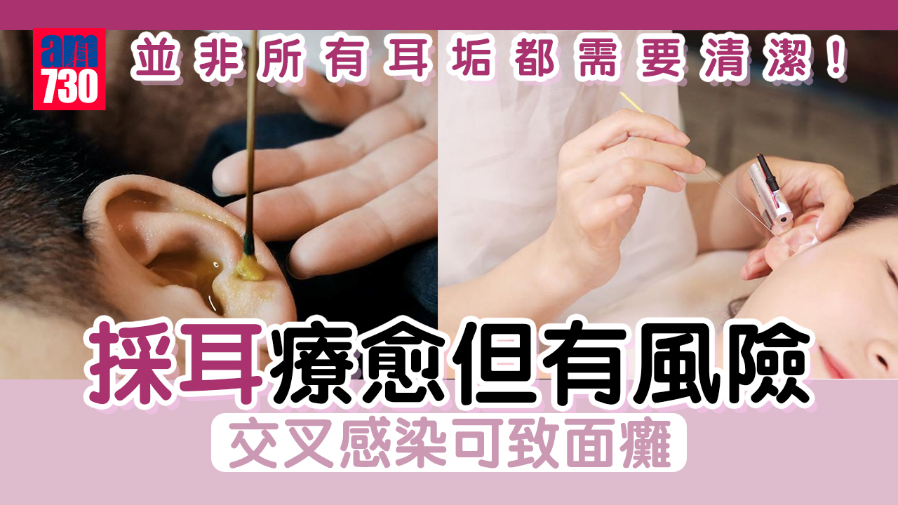 採耳療愈但有風險 受傷發炎可致面癱