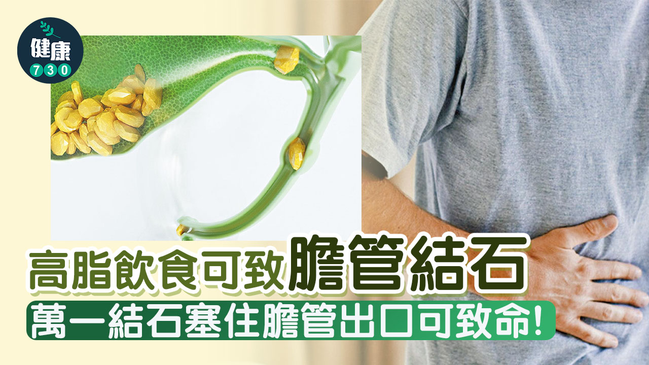 高脂飲食可致膽管結石？
