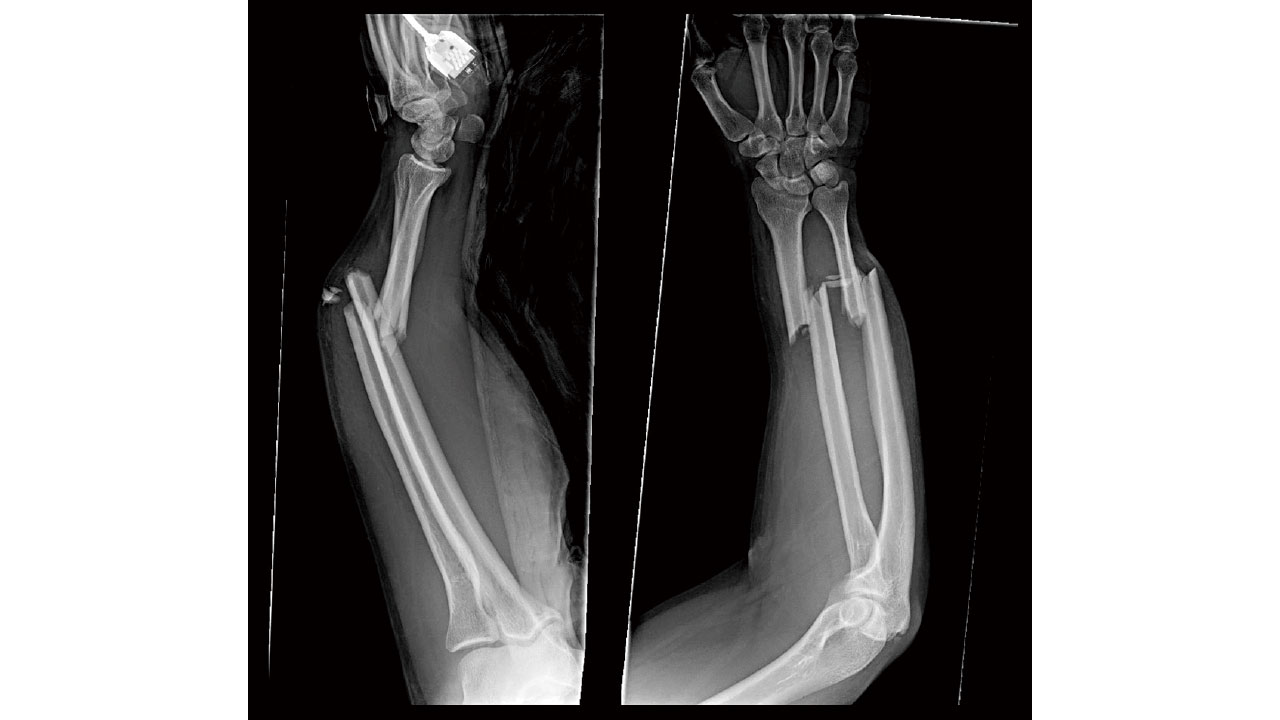 校服的自述： 有種分離叫做前臂骨折