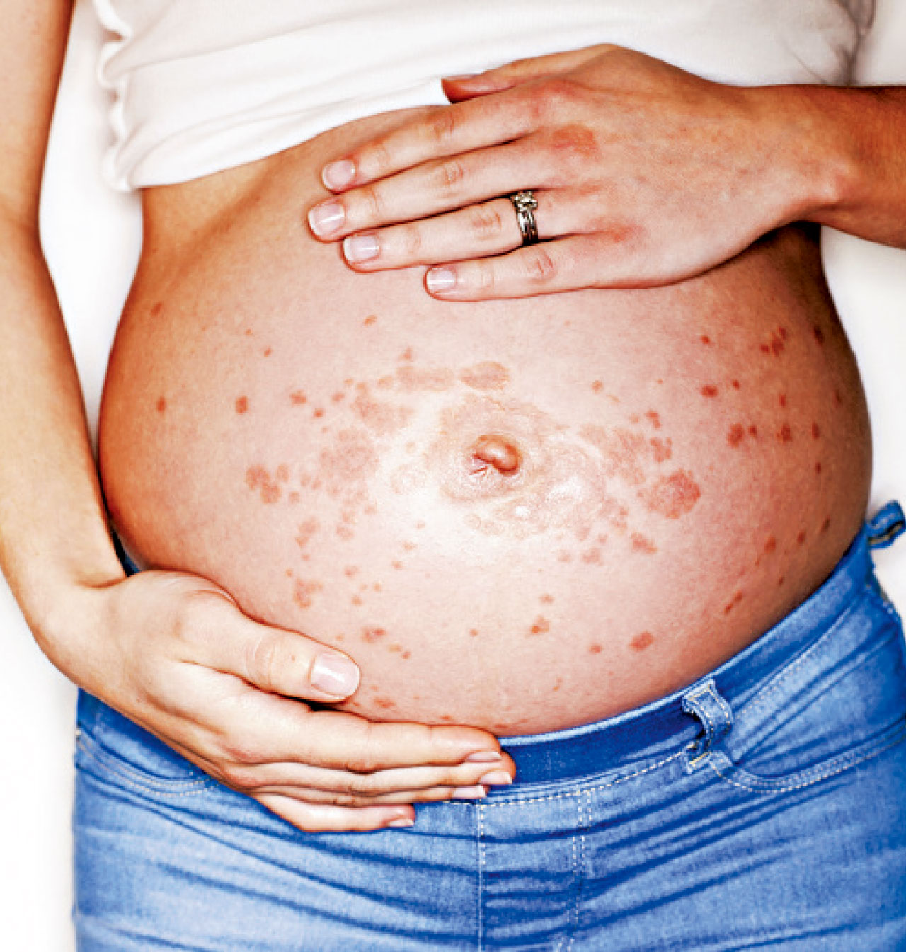 中醫治療懷孕期濕疹