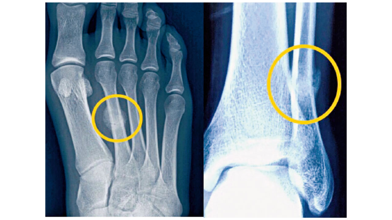 預防疲勞性骨折 休息是為了跑更遠的路