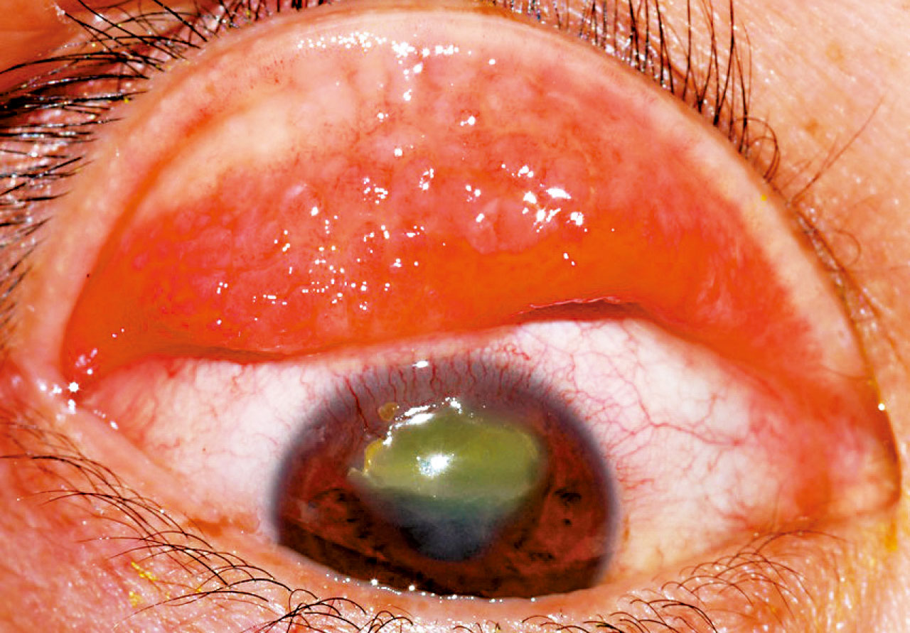 眼痕又眼矇或患春季角膜結膜炎(下)