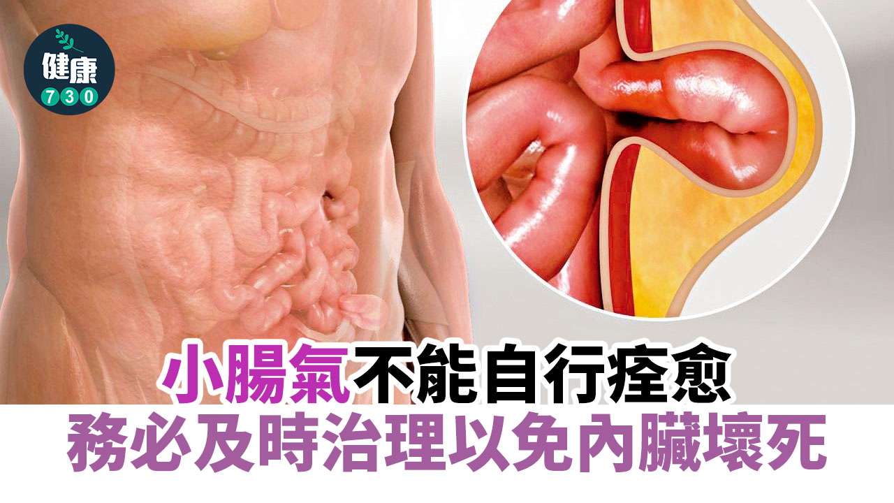 微創+新物料 修補小腸氣