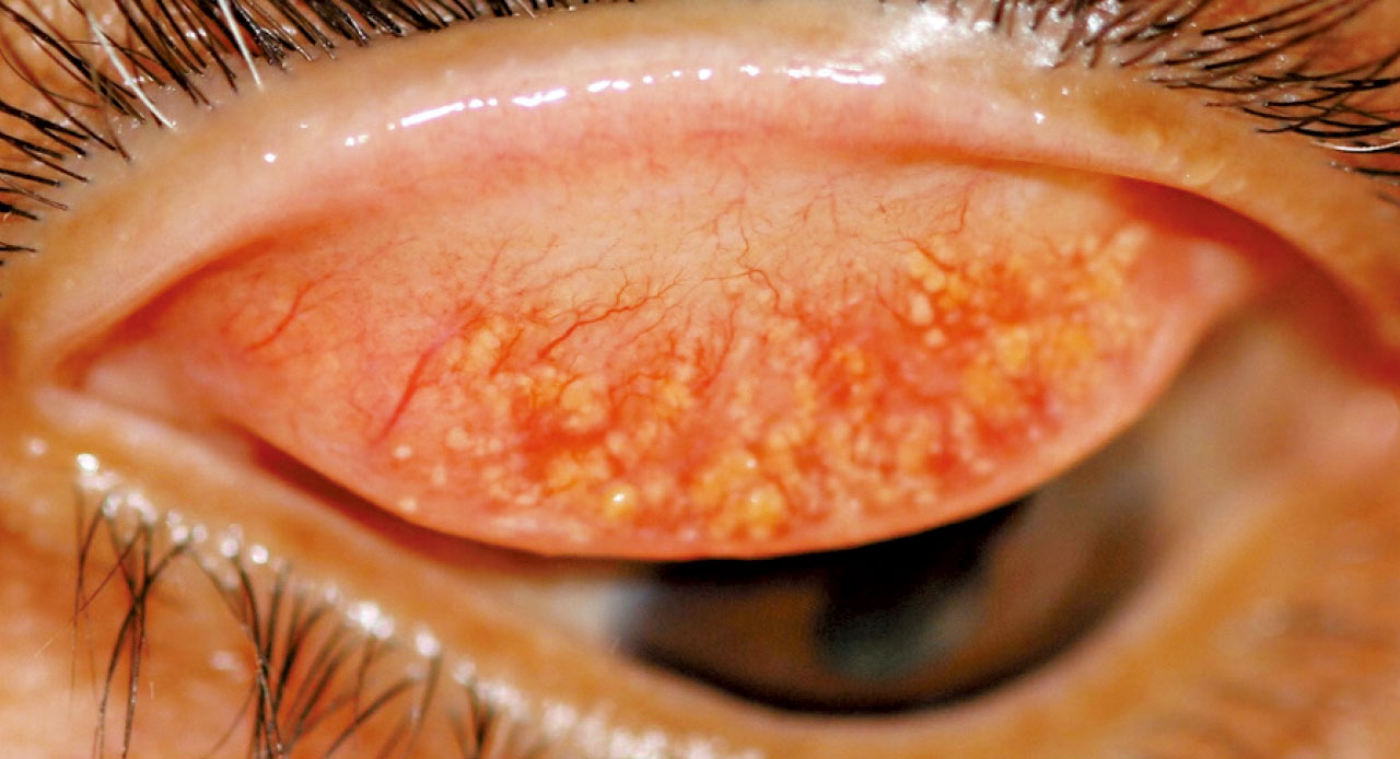 小小結石 大大不適