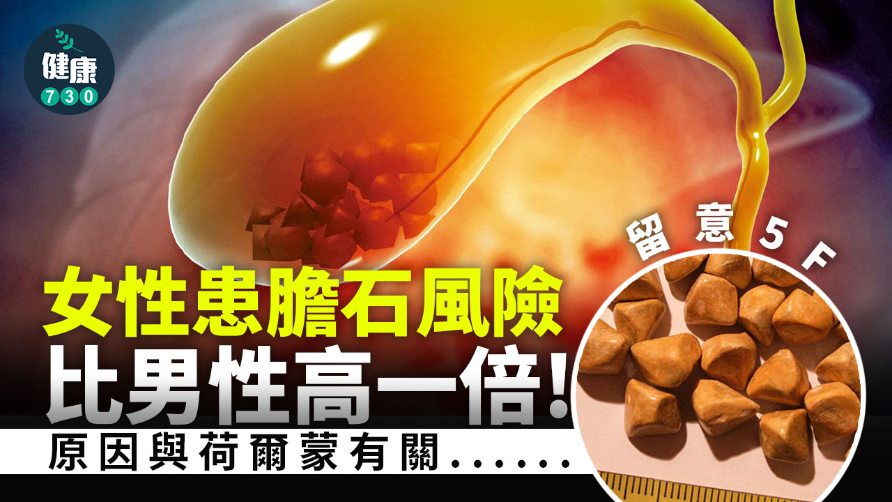 高危生膽石 留意5F