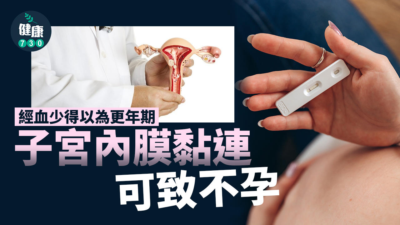 子宮內膜黏連 可致不孕