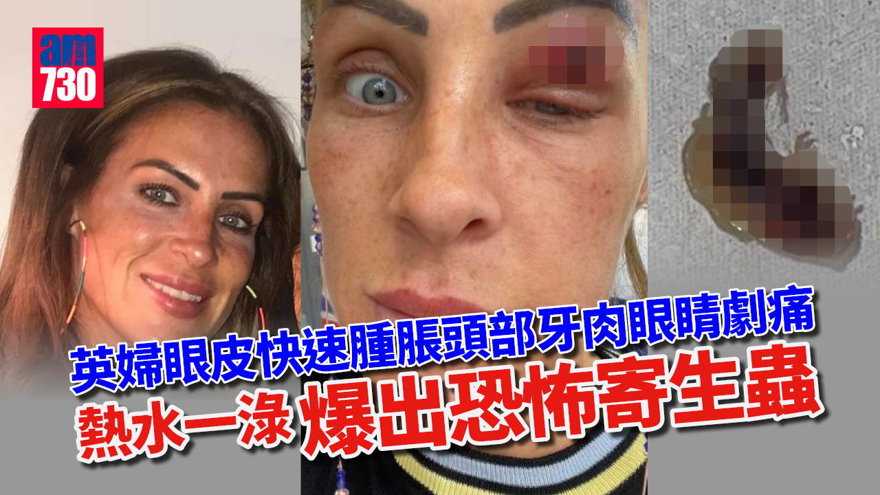 英婦眼皮快速腫脹 連帶頭部牙肉疼痛 熱水一淥即爆出「有腳異形寄生蟲」