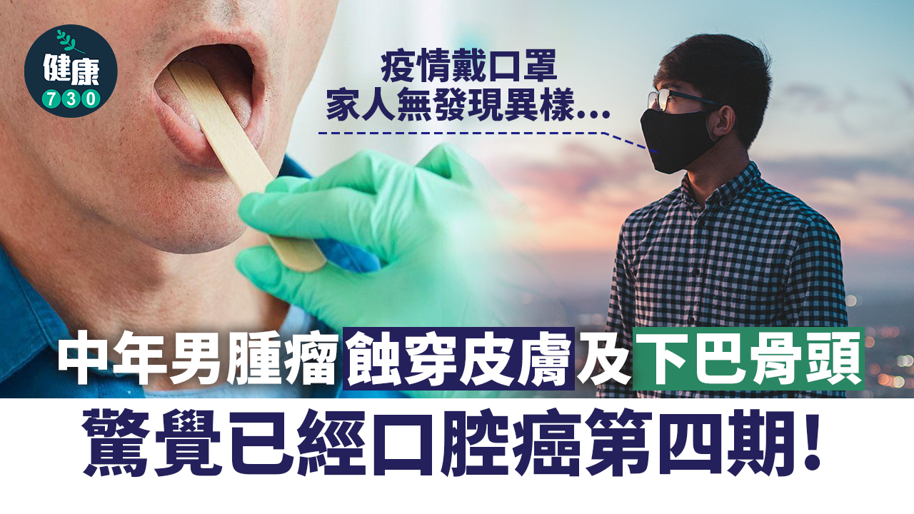 口腔癌「食」穿下巴！中年男口罩遮面確診已第四期