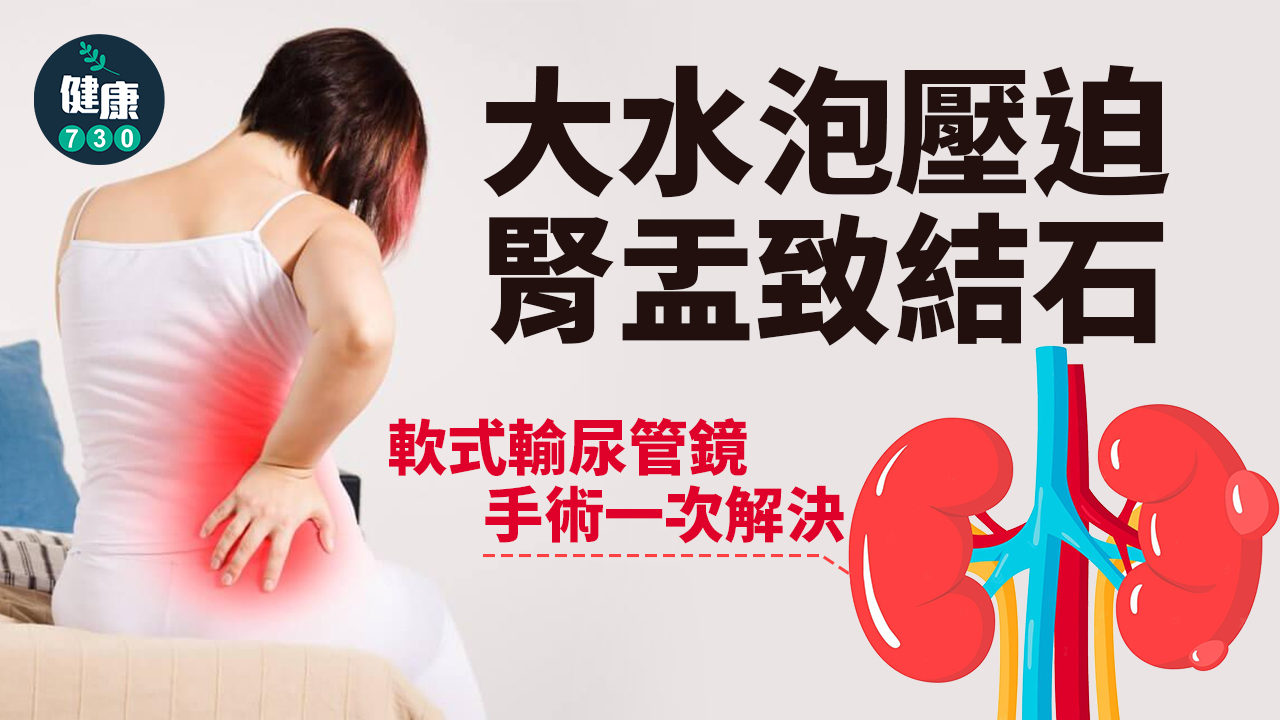 大水泡壓迫腎盂致結石 軟式輸尿管鏡手術解決疼痛