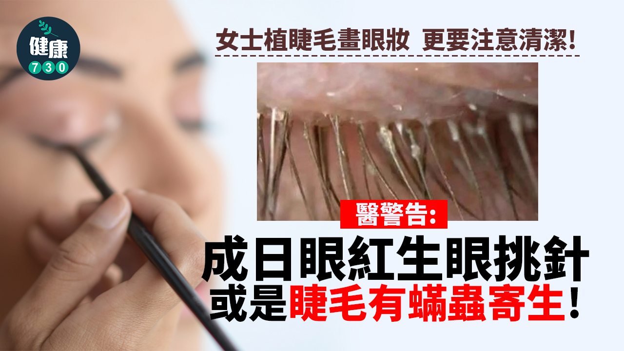 眼挑針｜成日眼紅眼挑針 醫警告：睫毛有蟎蟲寄生！