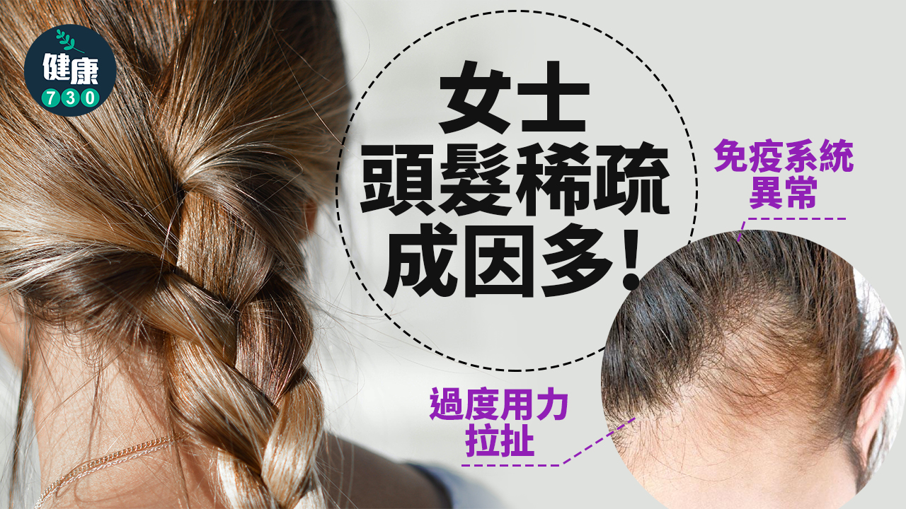 正確診斷成因 解決女士頭髮稀疏