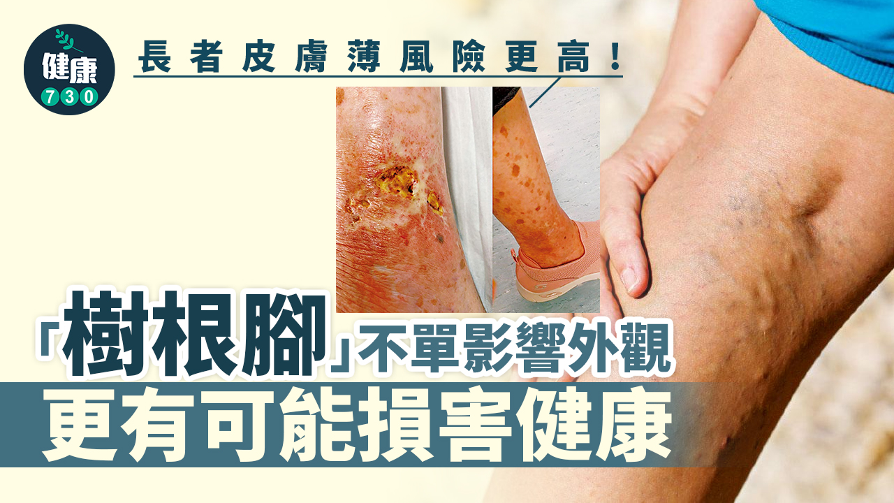 靜脈曲張 可致皮膚嚴重潰瘍