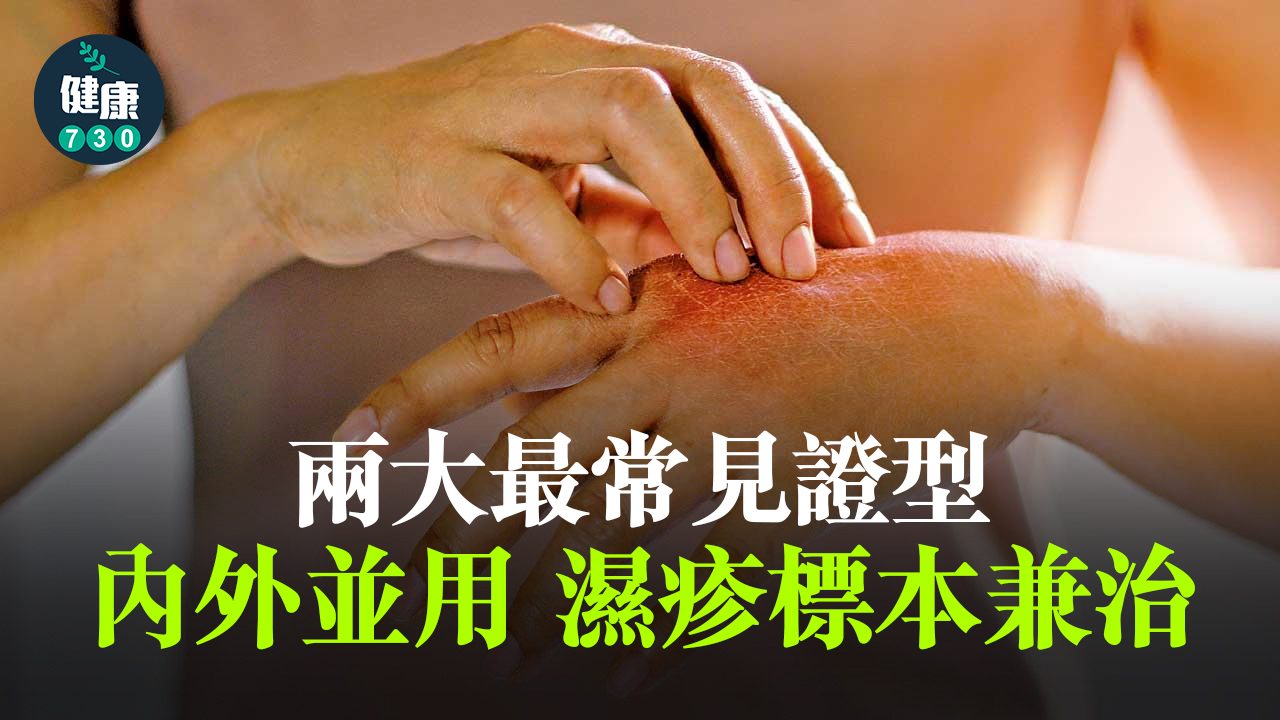 內外並用 濕疹標本兼治