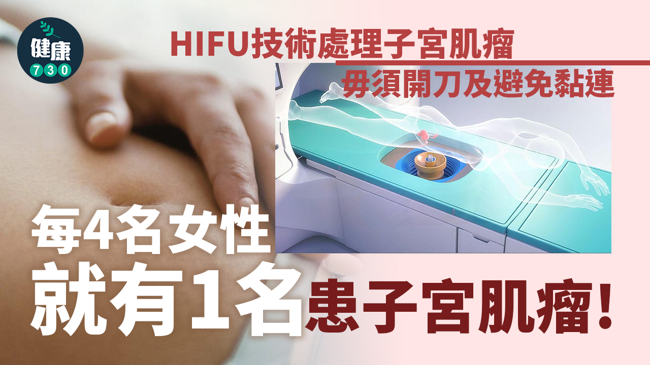 HIFU免開刀 治療子宮肌瘤