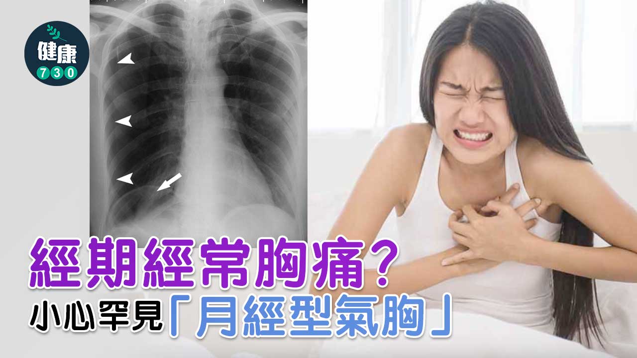 經期經常胸痛？小心罕見「月經型氣胸」