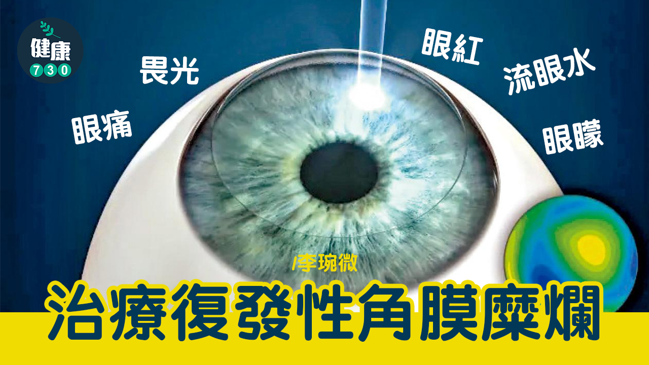 治療復發性角膜糜爛