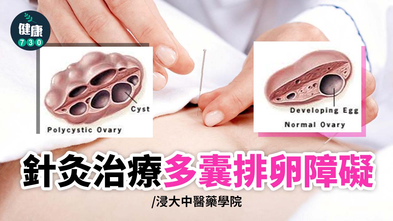 針灸治療多囊排卵障礙