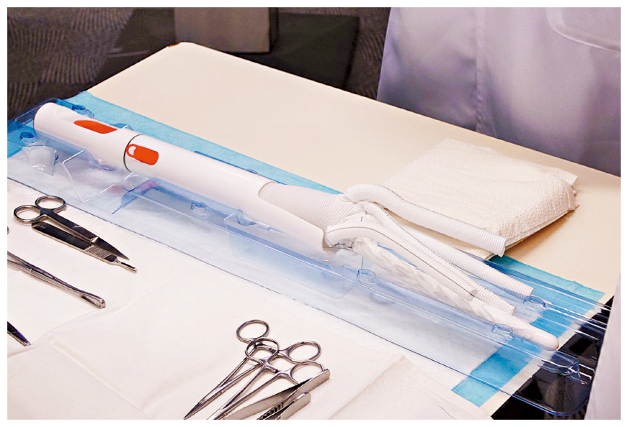 新型支架 一次過處理多部位主動脈瘤