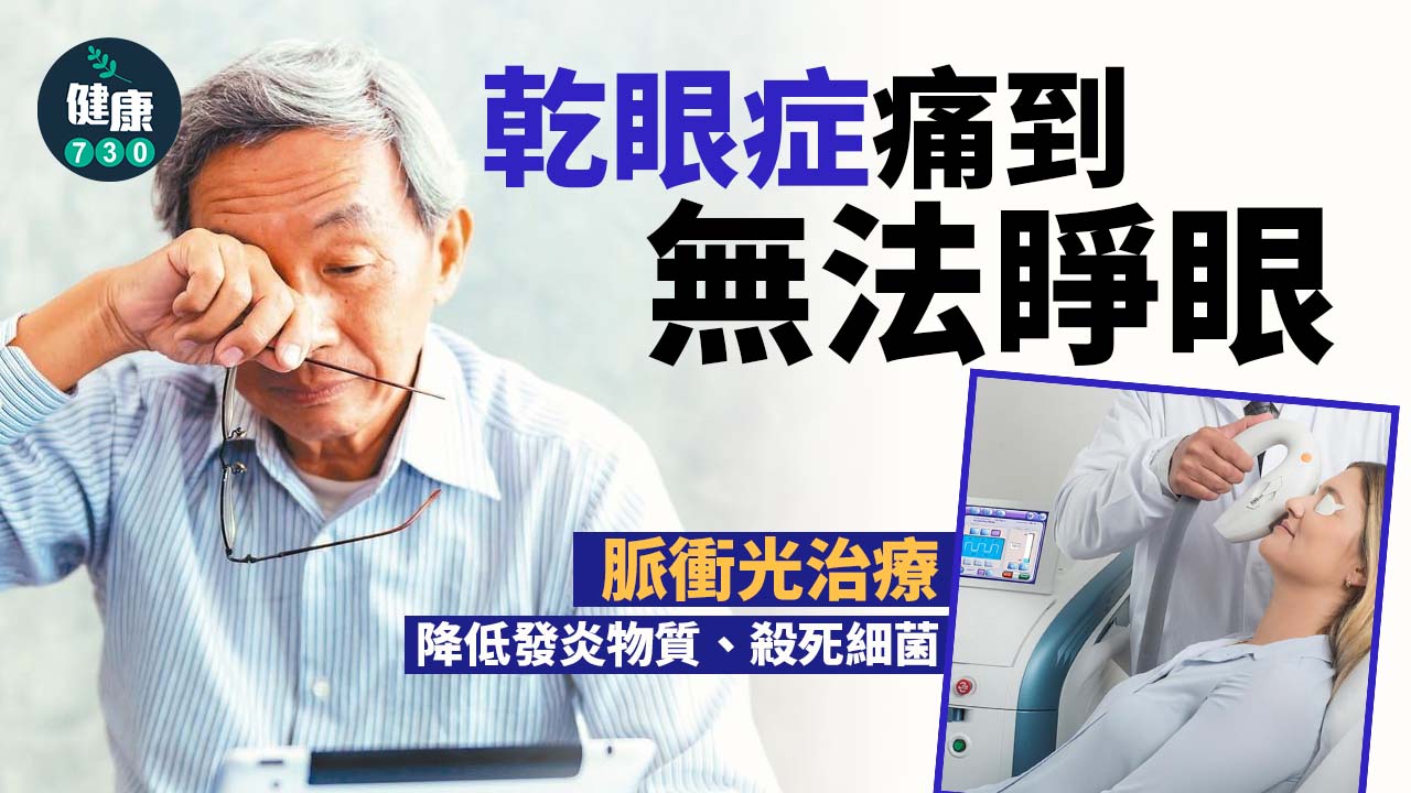 乾眼症痛到擘唔開眼 脈衝光或有幫助