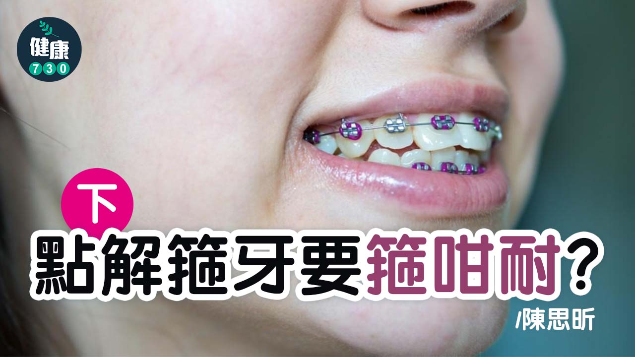 點解箍牙要箍咁耐？(下)