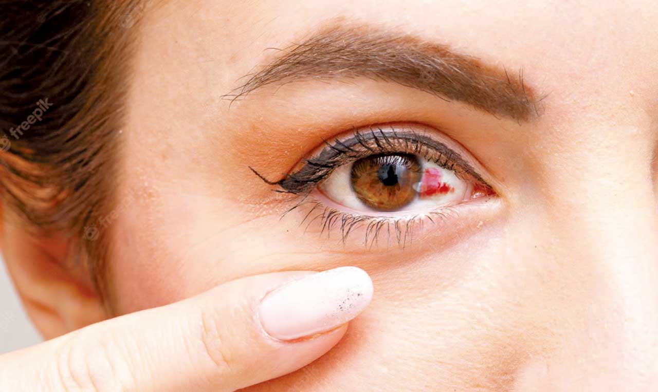 眼睛一片紅 結膜下出血