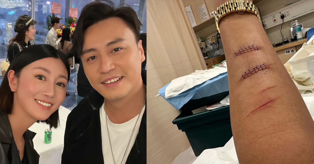 張建聲清潔焗爐變放血 左手縫14針