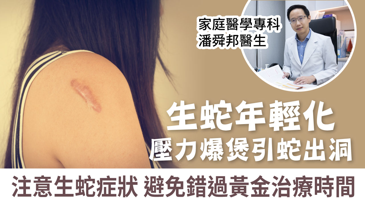 生蛇 | 生蛇年輕化 壓力爆煲引蛇出洞 注意生蛇症狀避免錯過黃金治療時間