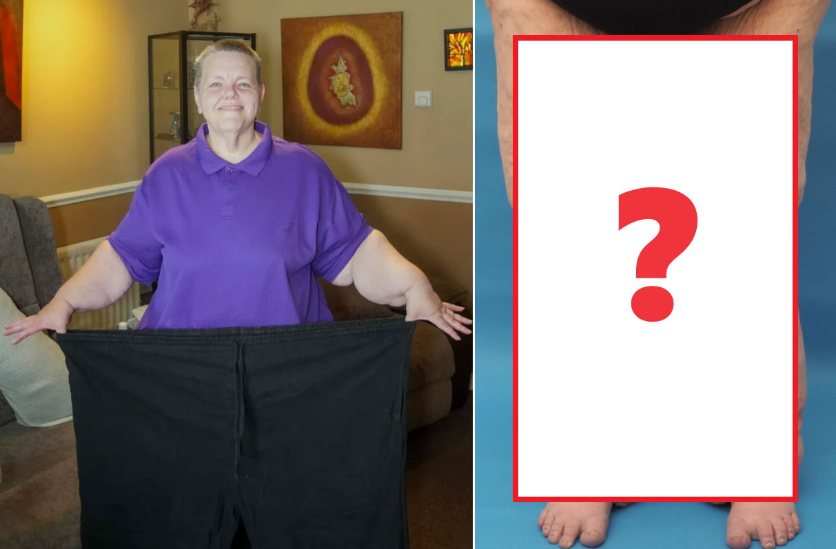 女子被丈夫瘋狂餵食至560磅 慘變「象人」無法站立 日飲6公升可樂