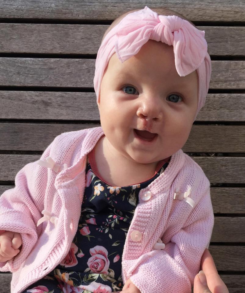 天生無上唇 可愛B女手術後展歡顏