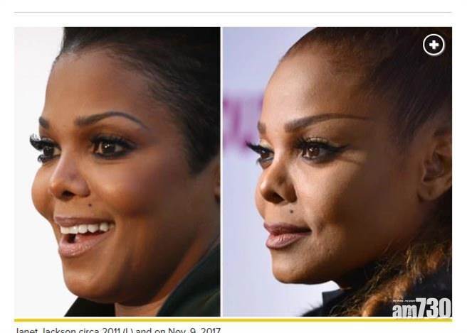 【即時娛樂】珍納積遜鼻子塌陷