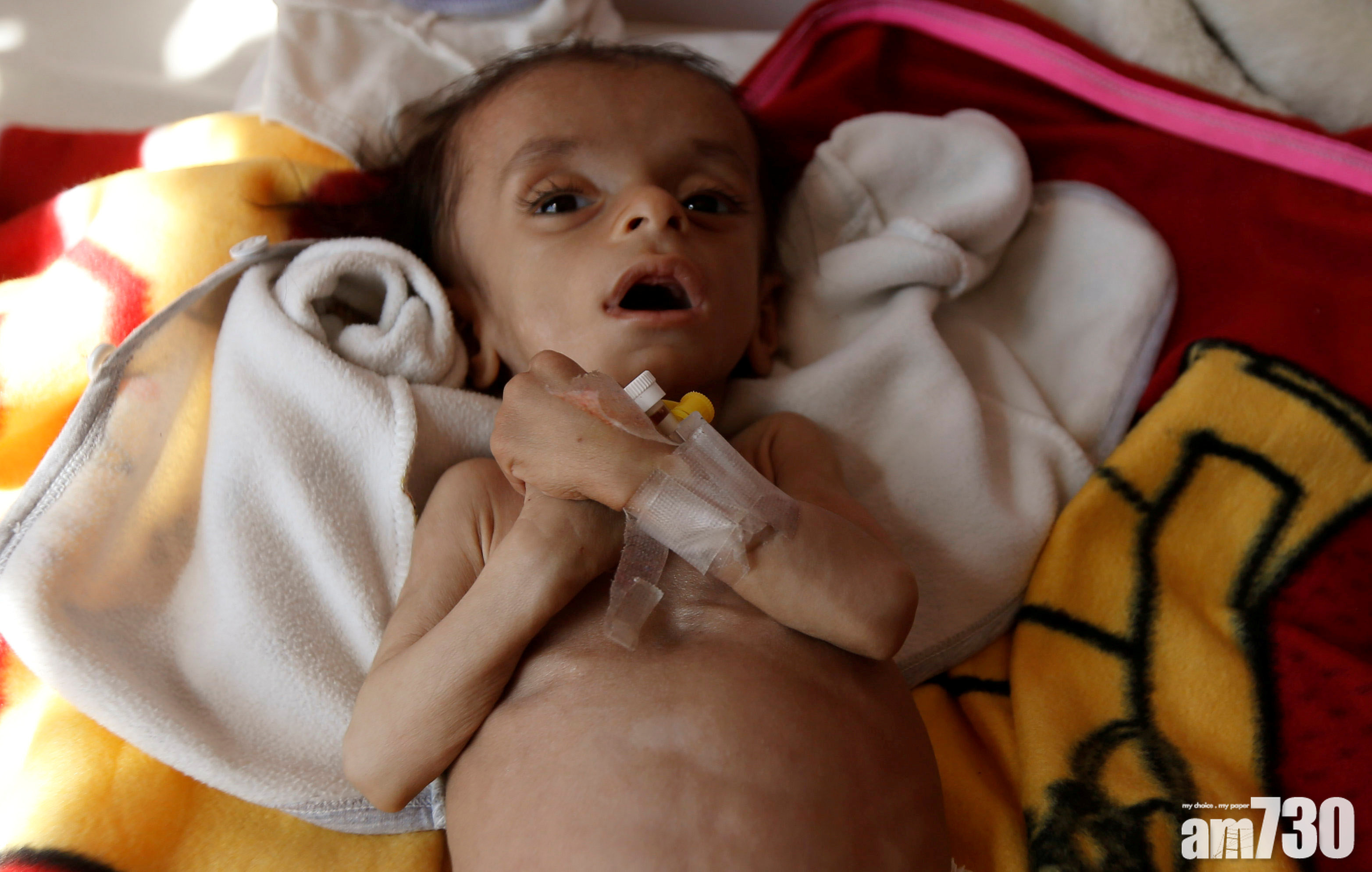 【救救孩子】也門孩童瘦至見骨　國際組織促沙地解除封鎖