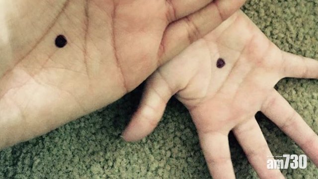 當家暴受害者掌心畫上黑點……
