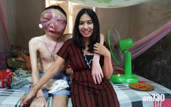 男友染眼疾毀容　泰女三年來不離不棄