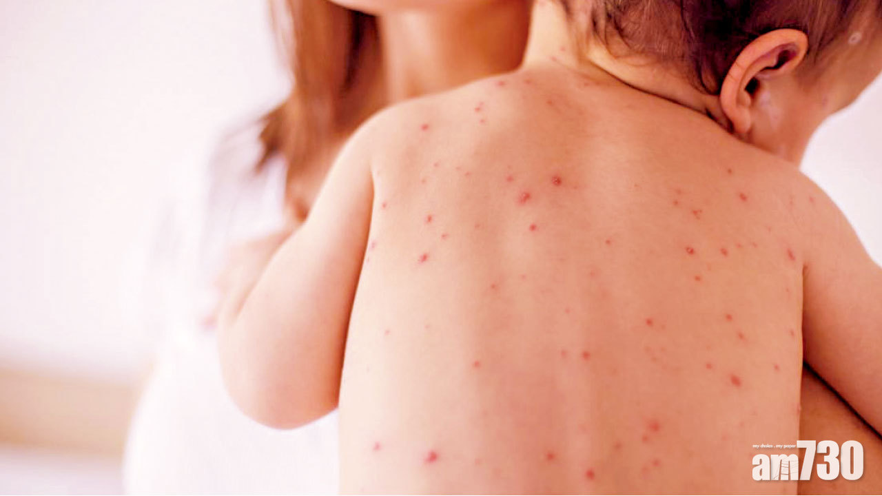 沖繩麻疹增至六十七宗 部分港旅團取消