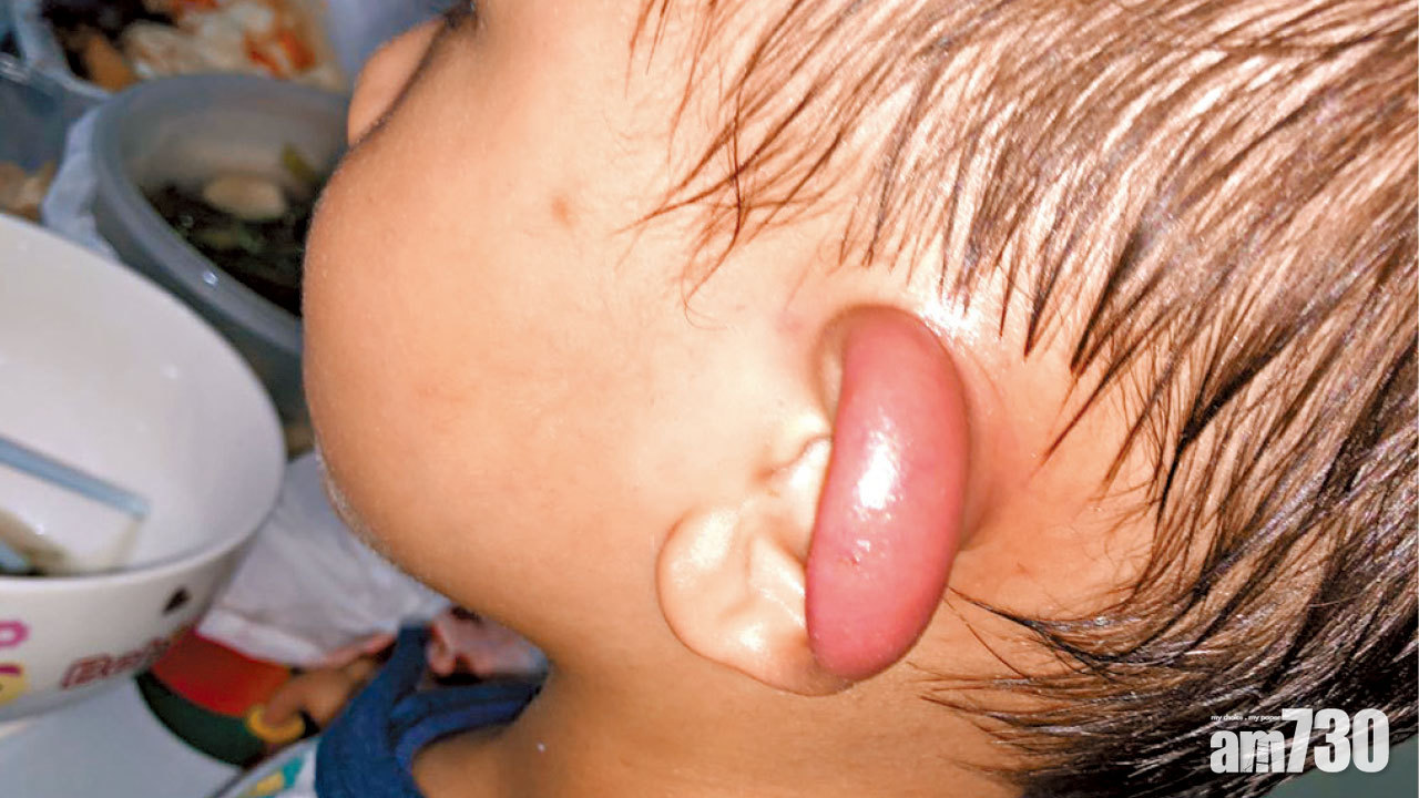 夏蚊來襲 防過敏感染