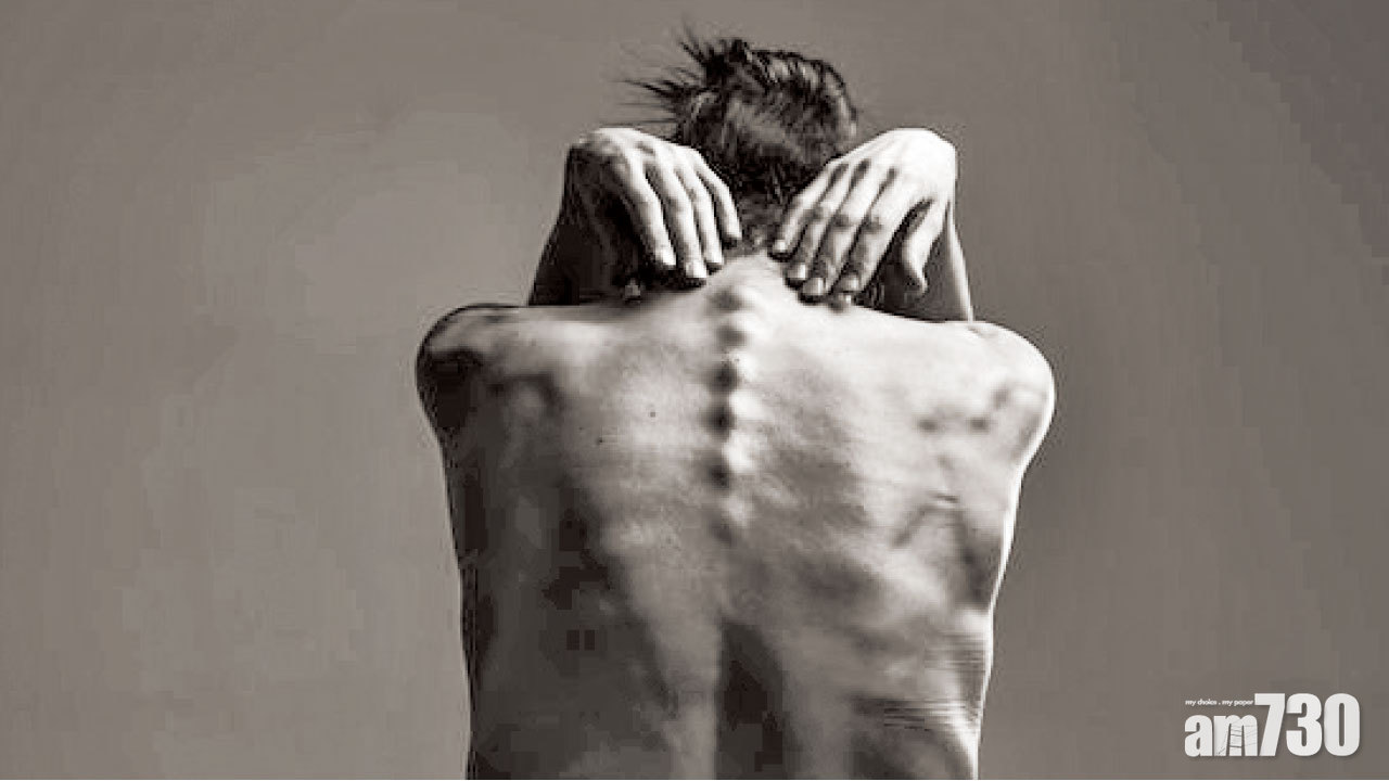 椎間盤突出壓神經 微創切除緩痛楚