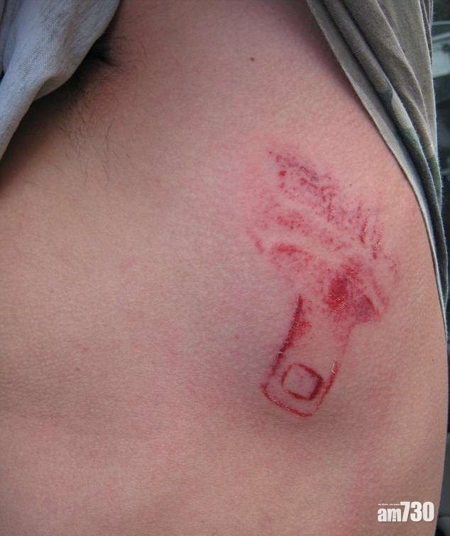 膚烙扣印成罪證