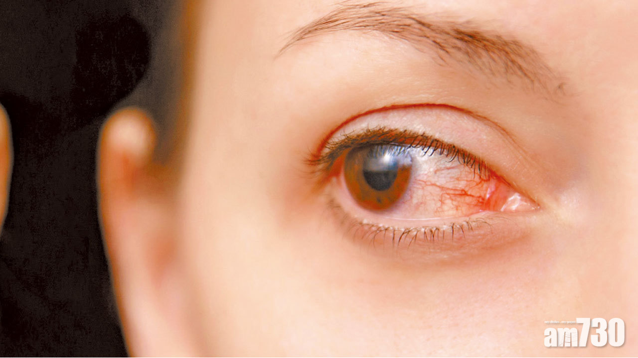 眼凸遭歧視 手術治眼疾兼重拾自信