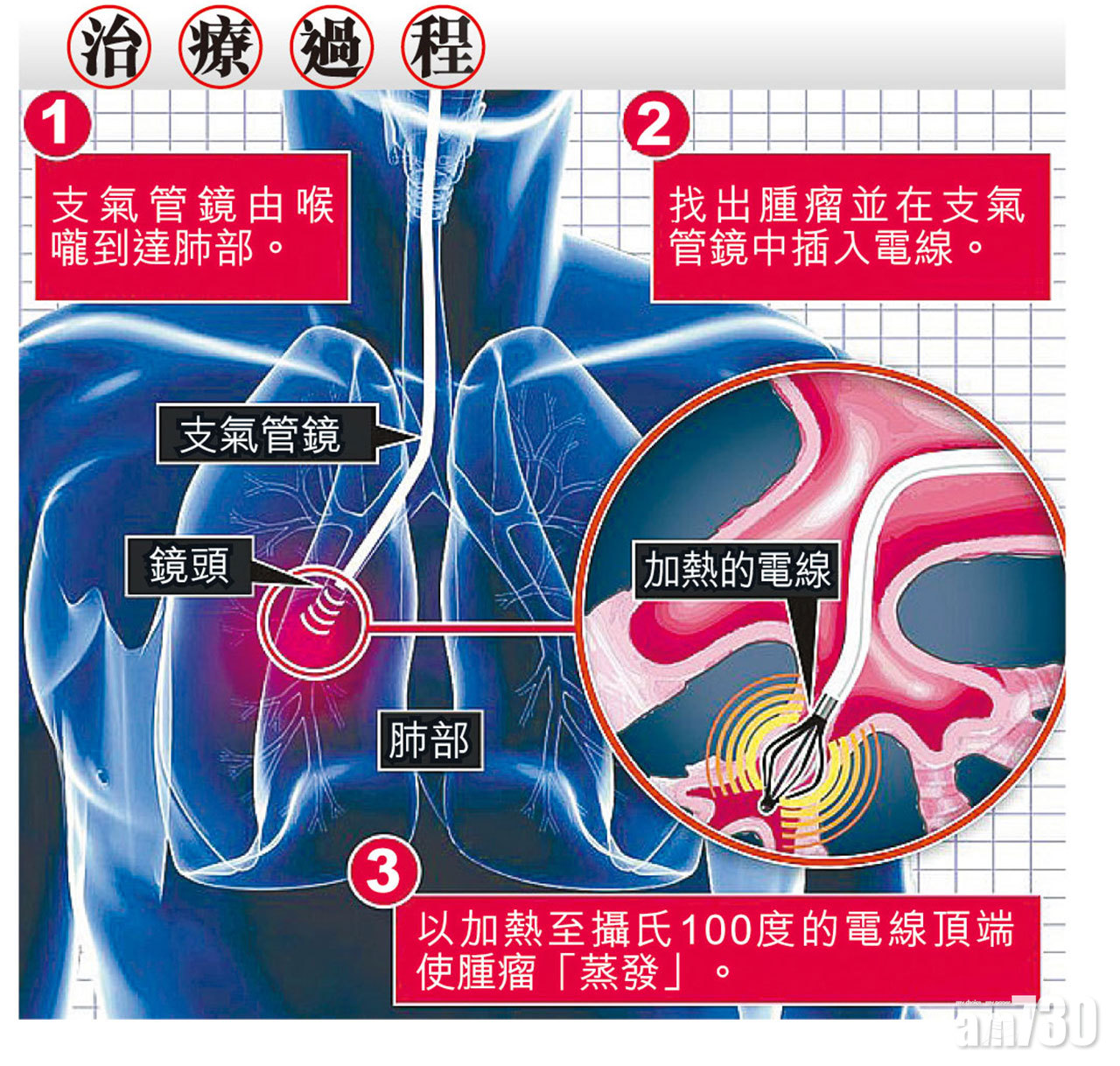 港人醫生率團隊創全球首例 無創「微波」治肺癌