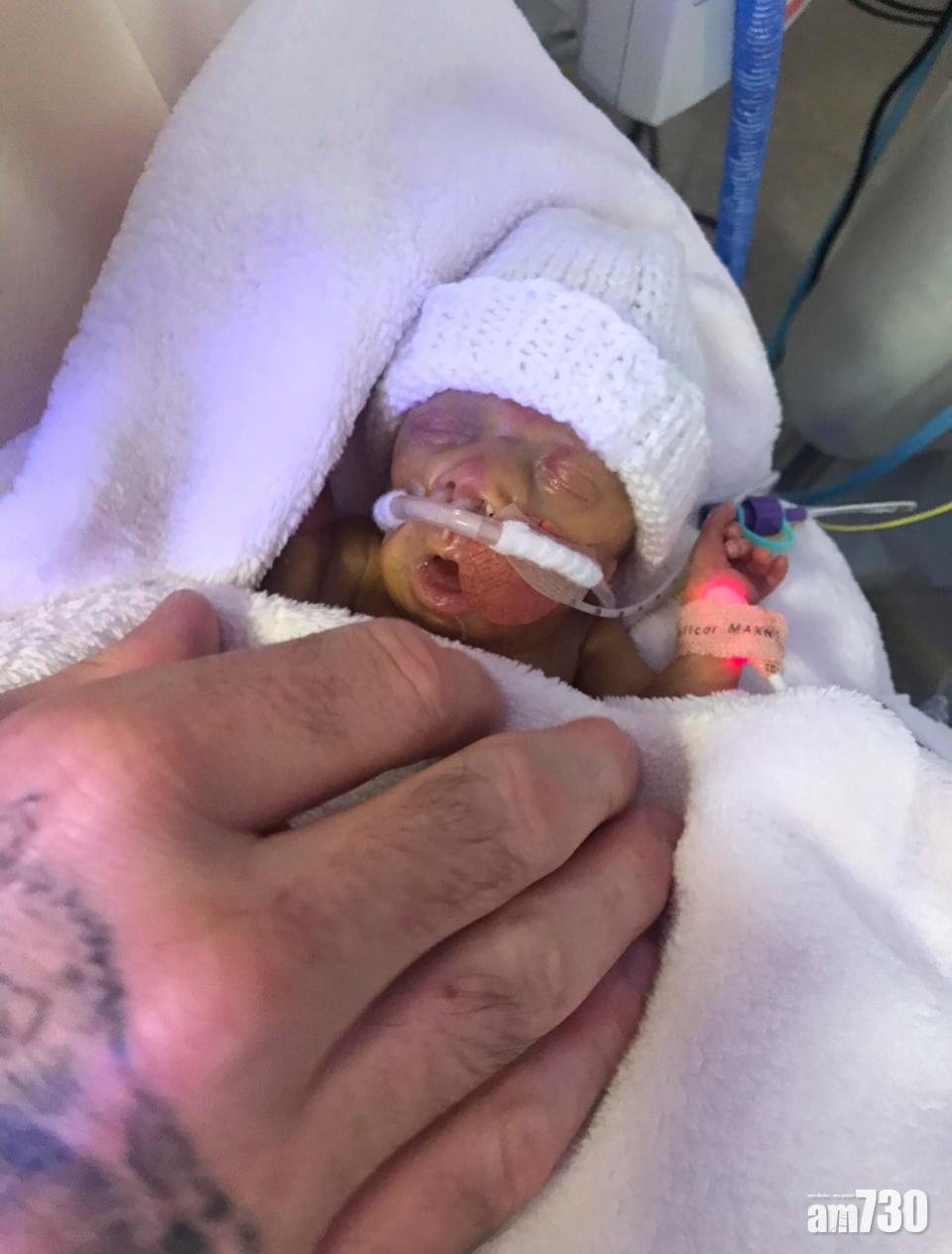 【頑強生命力】生存機會得百萬分之一  23周早產嬰奇蹟存活